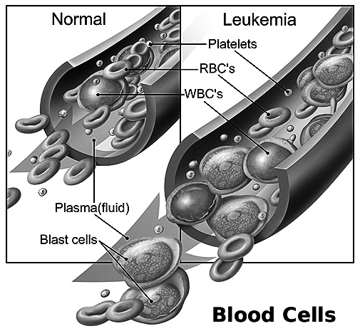 blood cells normal leukemia