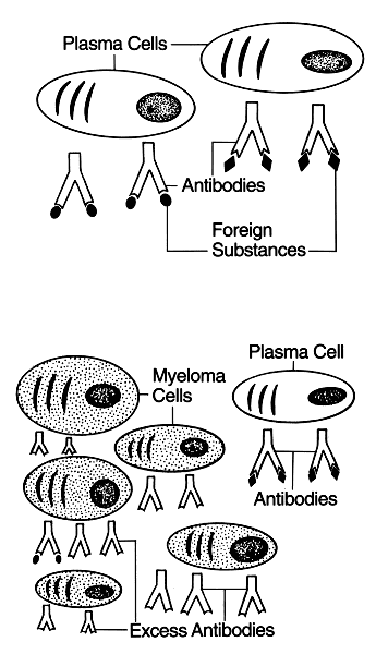 multiple Myeloma