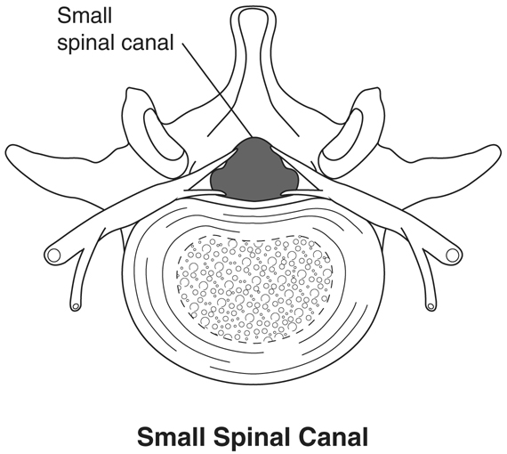 Small Spinal Canal