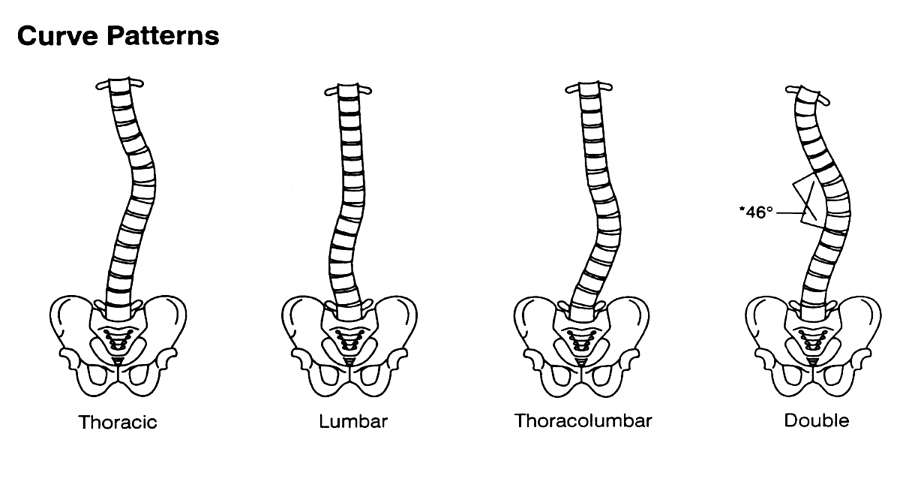 spinal curve patterns