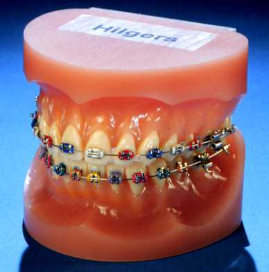 Braces on a dental model