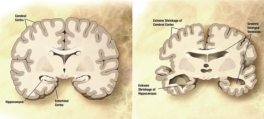 Alzheimers disease brain comparison