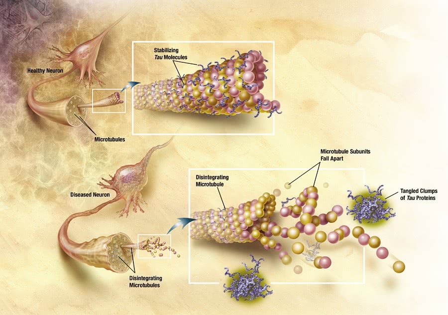 Alzheimers microtubules desintegrate