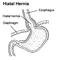 Hiatal Hernia