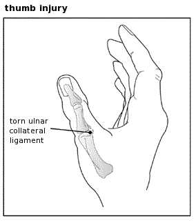 Thumb injury