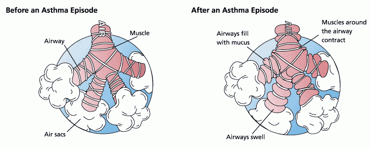 Asthma before after