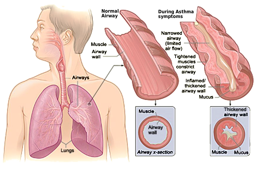 asthma airways