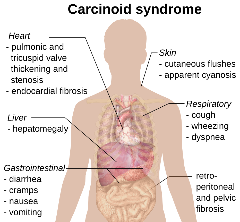 Carcinoid syndrome presentation
