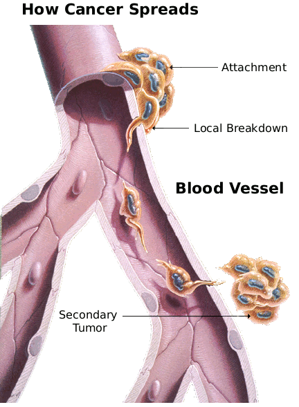 Metastasis  how cancer  spreads