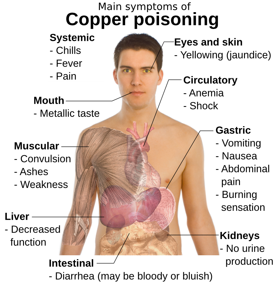 copper poisoning