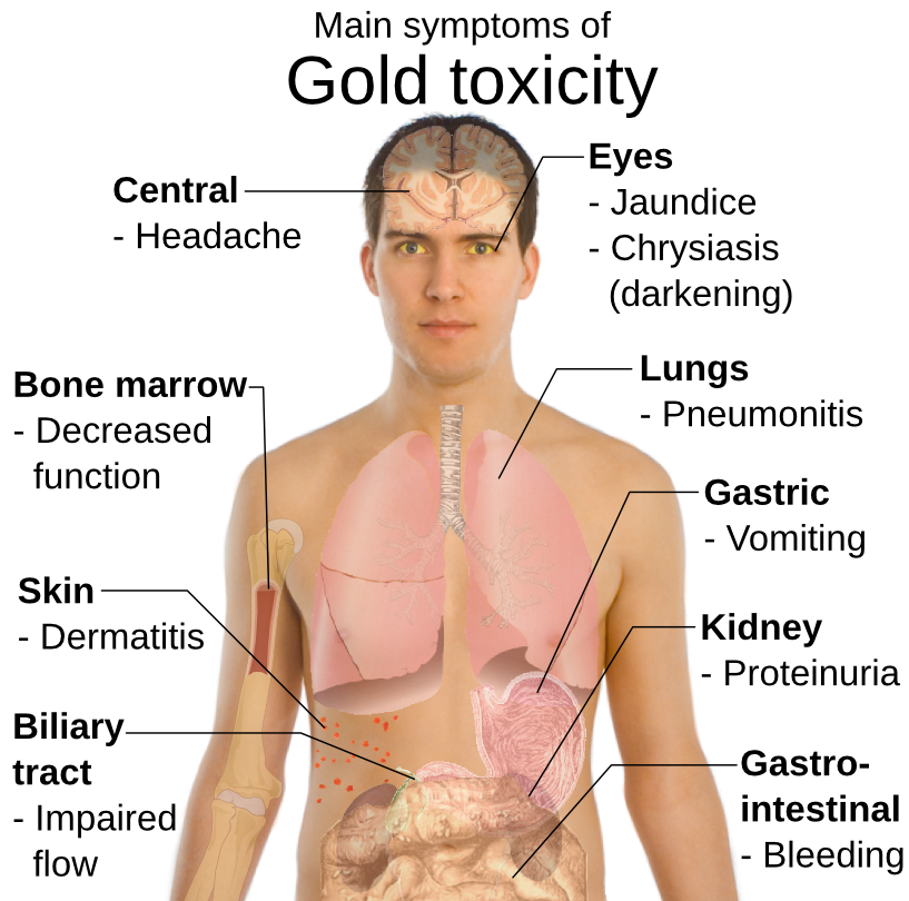 gold toxicity symptoms