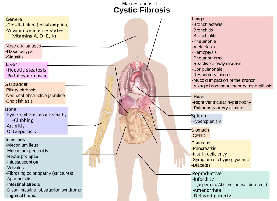 Cystic fibrosis manifestations