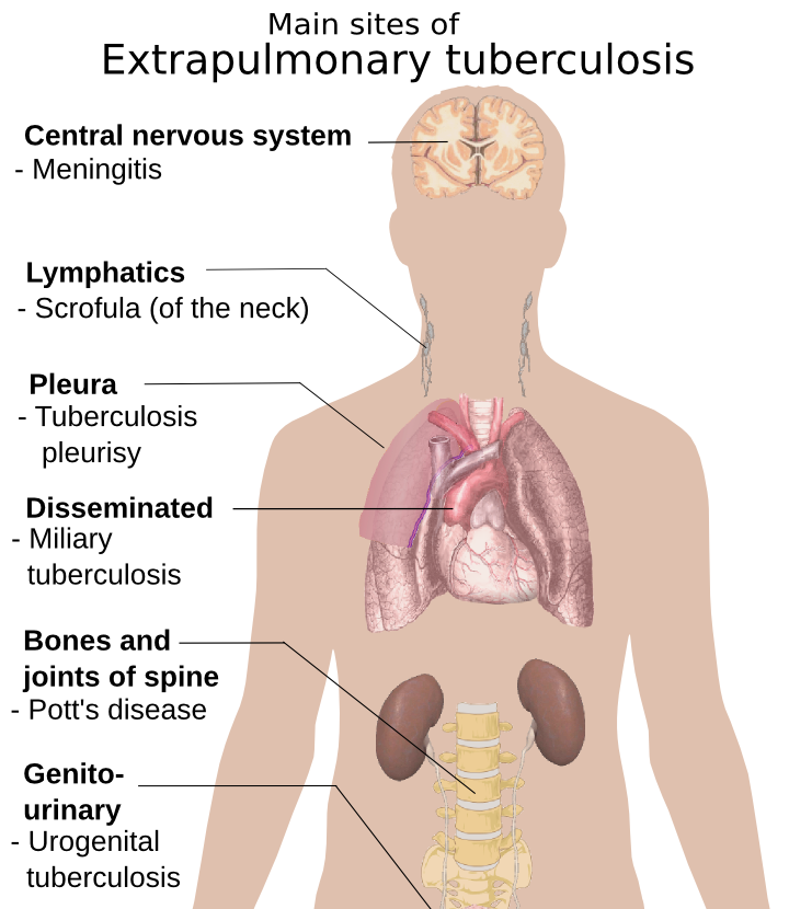 Extrapulmonary tuberculosis symptoms