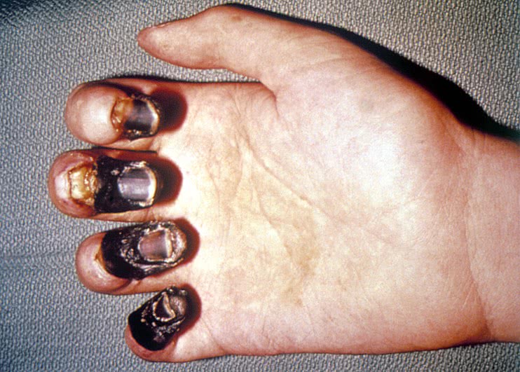 acral gangrene from plague