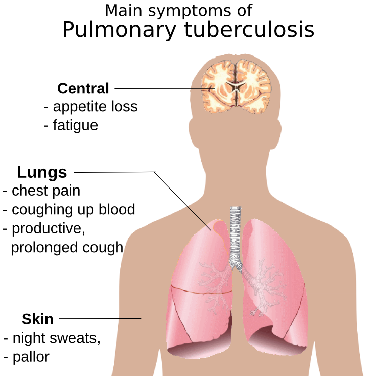 Pulmonary tuberculosis symptoms