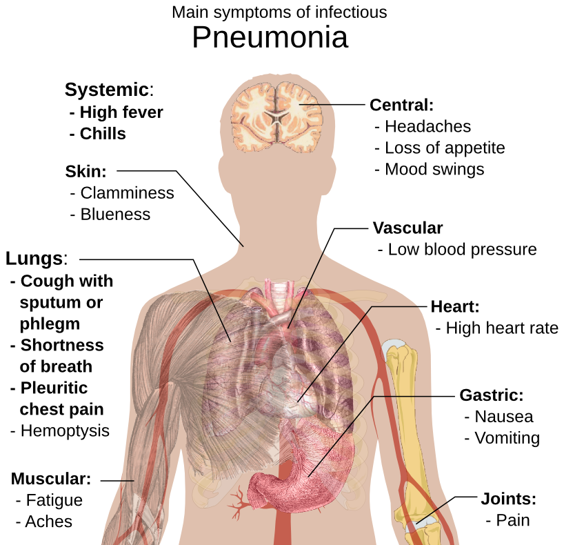 pneumonia symptoms