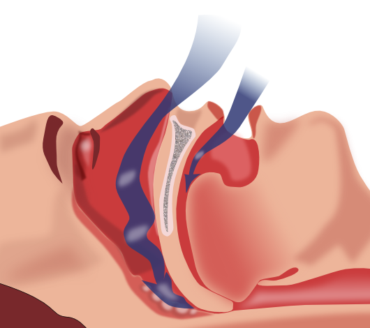 sleep apnea  obstruction