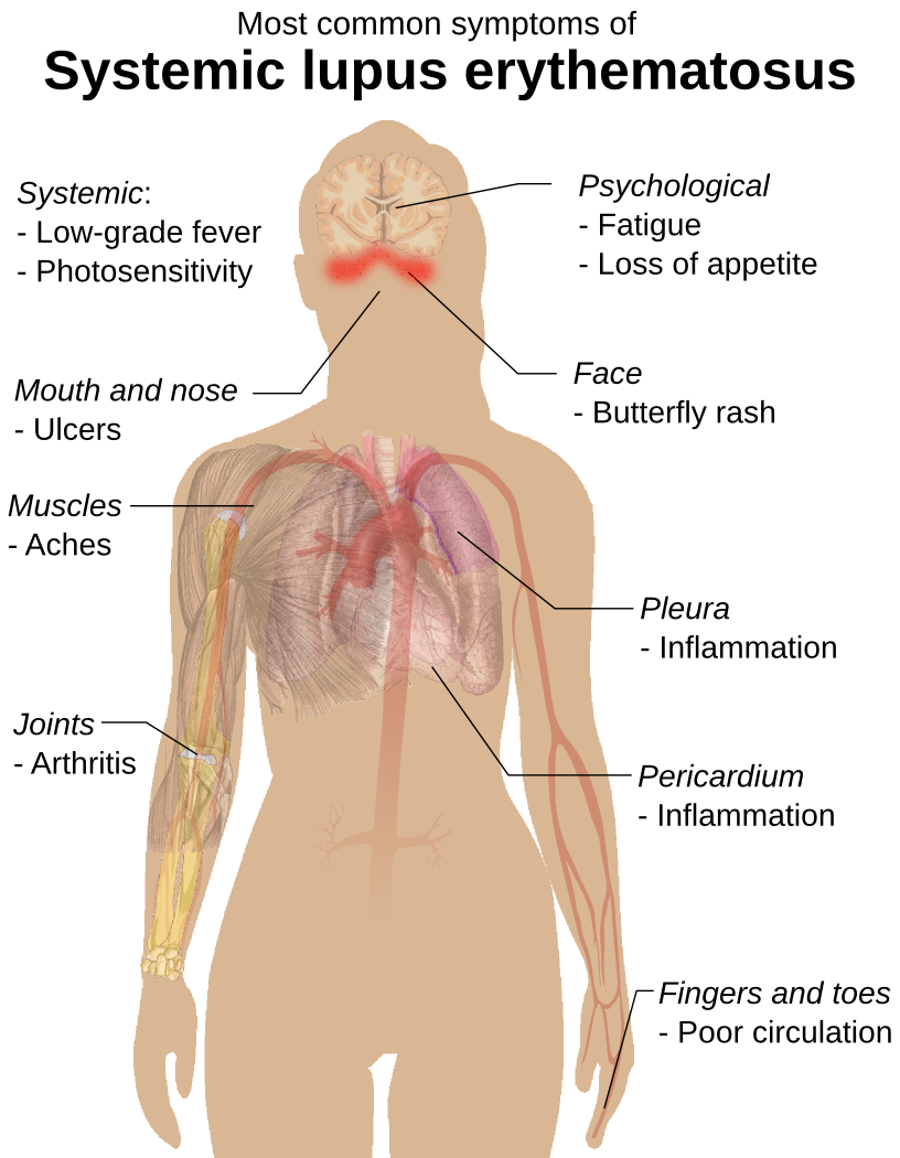 systemic lupus erythematosus symptoms