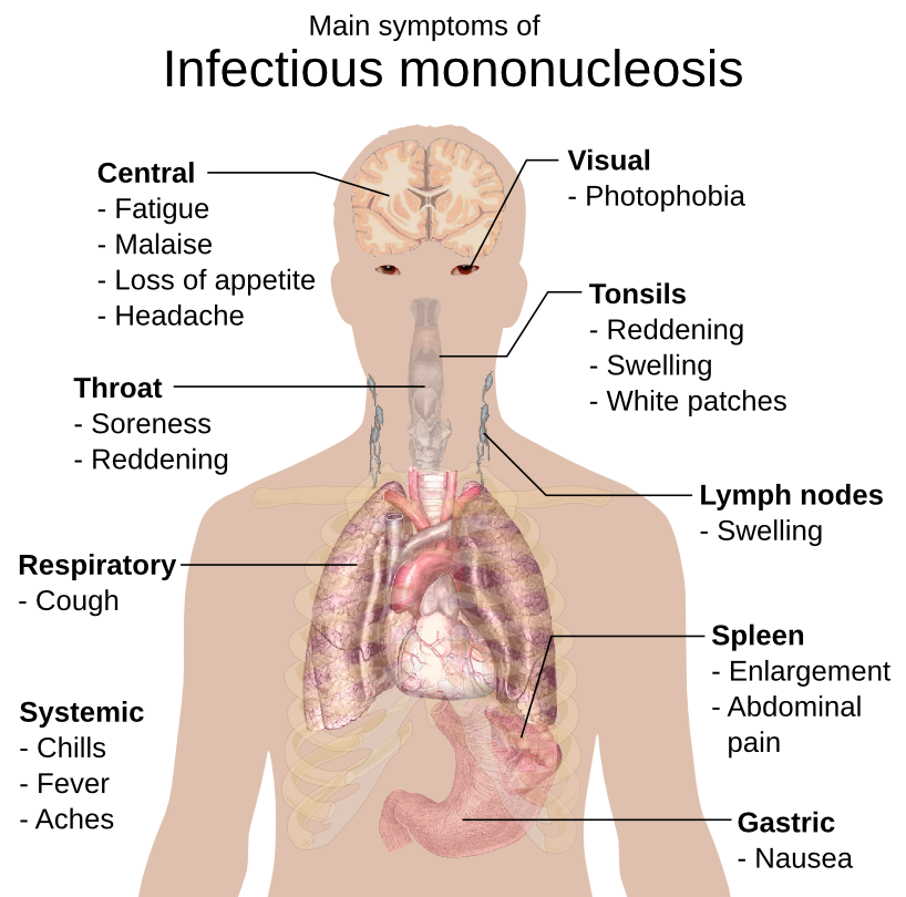 infectious mononucleosis symptoms